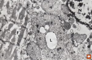 M, 7w. | mitochondrial cardiomyopathy … (N … nucleus, F … myofilaments,L … lipid droplets surrounded by megamito